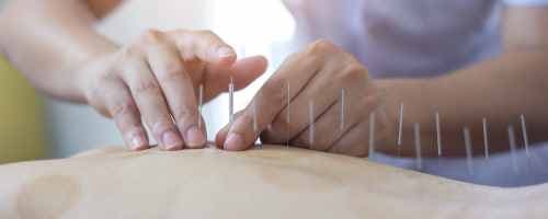 Acupuntura: Conheça a História da Prática Milenar e Sua Presença no SUS