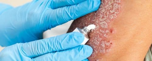 Dermatite Atópica: Estratégias de Enfermagem no Manejo e Controle