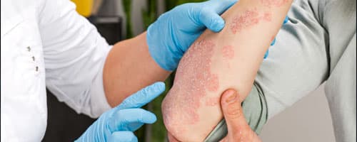 Psoríase: enfermeiros dermatológicos ajudam a promover qualidade de vida para os pacientes