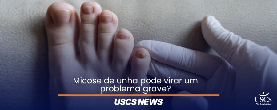 Infecções ungueais: riscos, sinais e prevenção clínica