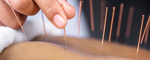 Os 10 principais pontos da acupuntura no corpo