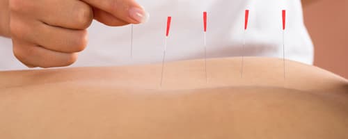 Benefícios da Pós-graduação em  Acupuntura para profissionais da Estética