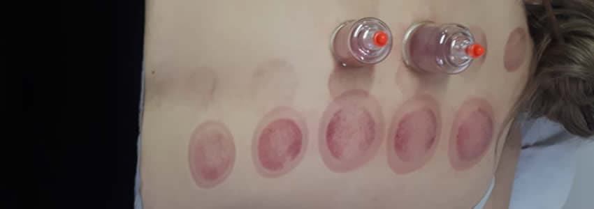  Aula prática de Acupuntura e Moxabustão