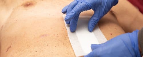 Feridas Complexas: Abordagem Integrada na Enfermagem em Estomaterapia