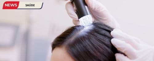 Sociedade de Tricologia (SBTri) é contra o uso de Minoxidil oral