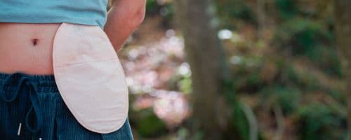 Assistência de Enfermagem ao Paciente Ostomizado: Baixe um e-book gratuito sobre o tema