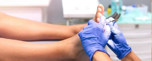 Pé Diabético: Pesquisadores desenvolvem tratamento com meias de tecido de fibra de carbono