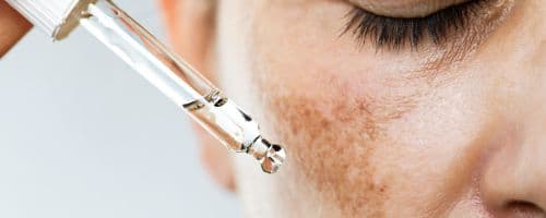 Melasma: Qual o melhor método de tratamento?