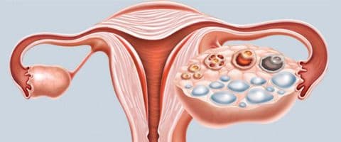 Síndrome dos Ovários Policísticos