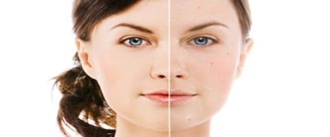 Dicas para acabar com cravos e espinhas