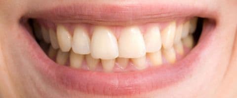 Por que os dentes amarelam?