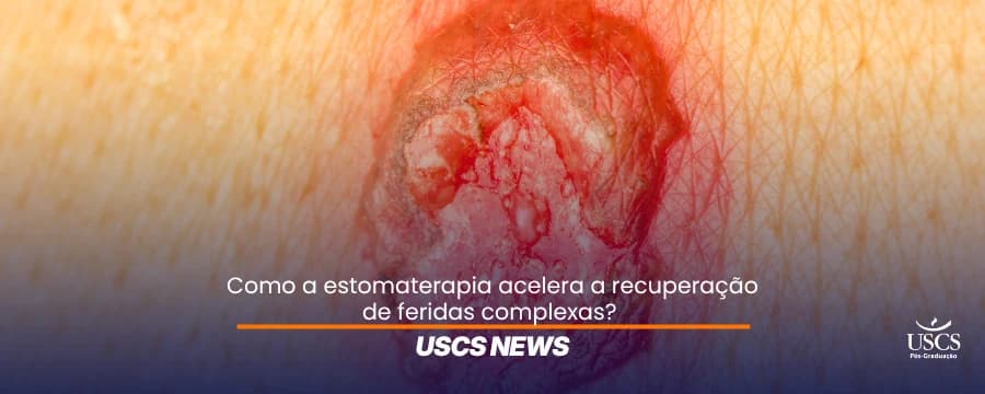 Feridas complexas: o papel do estomaterapeuta na cicatrização