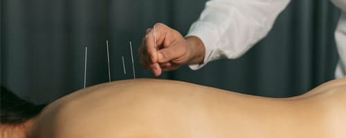 Confira alguns benefícios da acupuntura