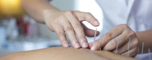 O que faz um acupunturista e onde pode atuar?