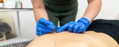 Você é enfermeiro e quer autonomia para trabalhar? Torne-se um especialista em Acupuntura.