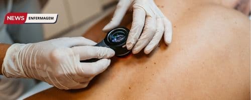 Os perigos do câncer de pele e a oportunidade de se especializar em Enfermagem Dermatológica