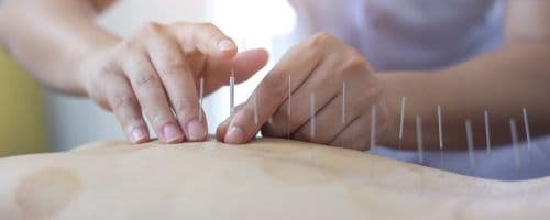 Acupuntura no Esporte: Tudo sobre o Tratamento de Lesões Esportivas